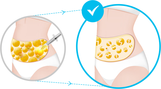展示ID V逻辑身体PT注射破坏脂肪细胞过程的画面