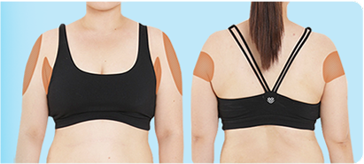 通过V逻辑身体PT注射手臂变细的图片