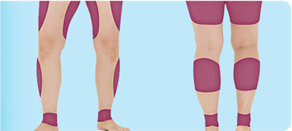 通过V逻辑身体PT注射腿部变细的图片