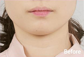 轮廓肉毒4种施术后V脸效果照片