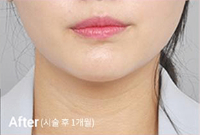 轮廓肉毒4种施术后V脸效果照片