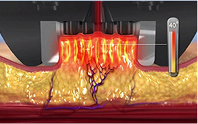 显示InMode FX模式对皮肤层影响的图片