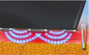 显示InMode FORMA模式对皮肤层影响的图片