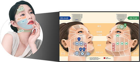 介绍适用于眉毛 侧眶 下眶 脸颊 上颈等不同脸型的美版超声刀探头种类