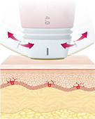 倾斜探头结构实现面部不同部位的精准提拉