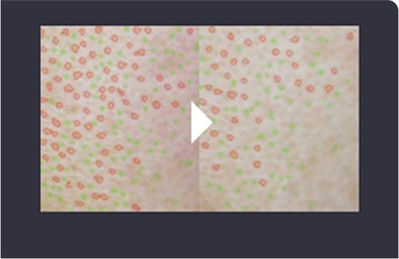 丽珠兰黑盒治疗4周后毛孔缩小对比图片