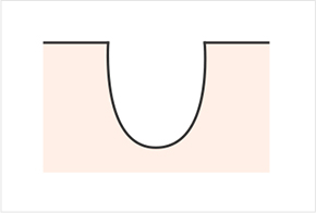 毛孔和疤痕的不同形状-冰锥形 圆盘形 盒子形
