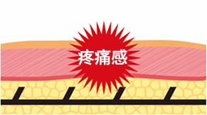 说明普通线雕术后线上的倒钩如何刺激神经导致疼痛